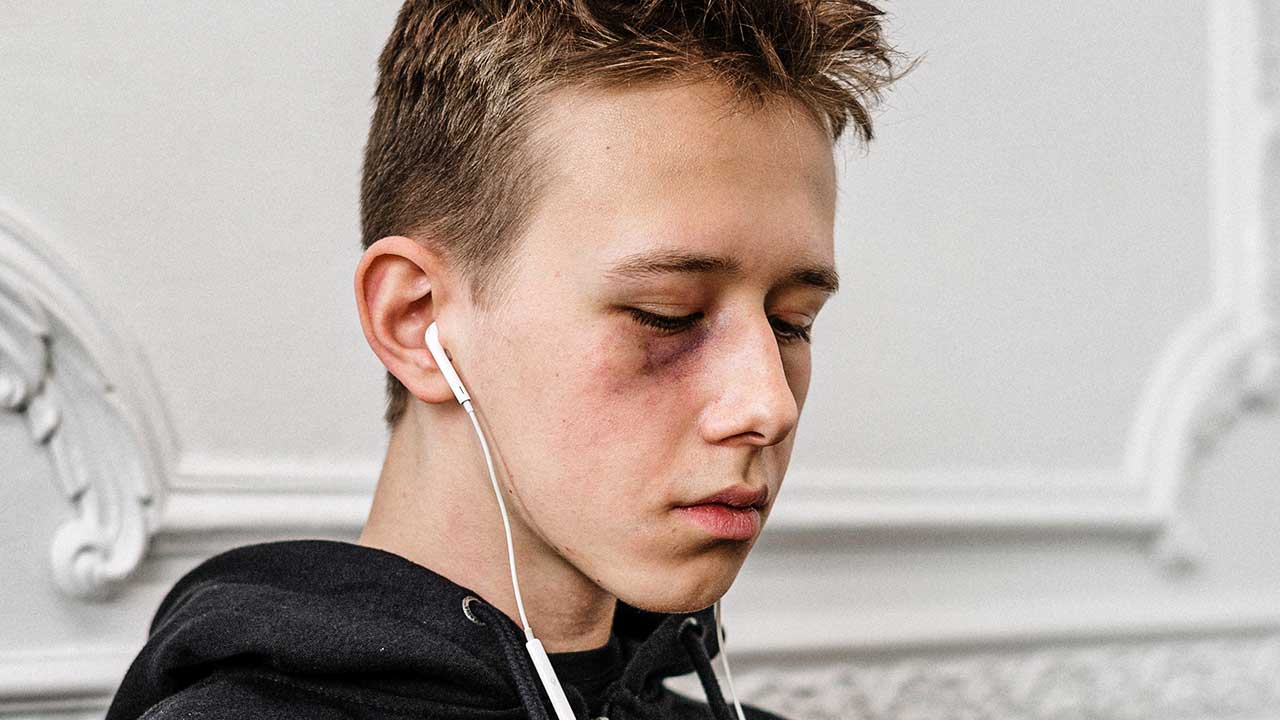 Junger Teenager mit Spuren von Gewalt im Bereich der Augen